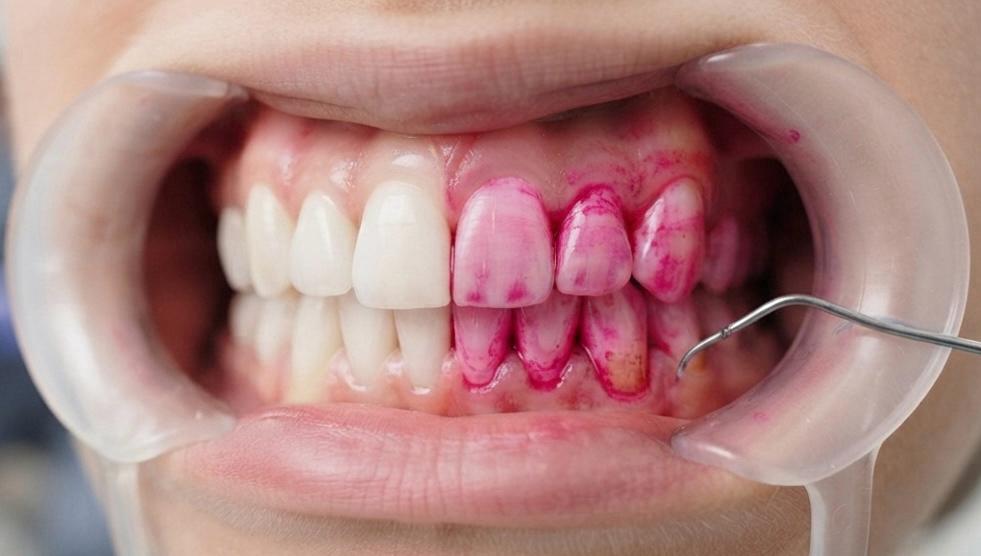 Limpeza odontológica